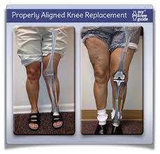 Propublica Misleads Patients About Surgical Complications Bow Legs Correction Bow Legs Correction Exercise Bow Legs