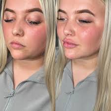Side Profile Balancing ⚖️ Subtle and Natural results using only 3ml of  dermal filler for a lifted tip, russain lips and chin projection.  💉Treatment- 3ml Package 💰Cost- £320 ⏳Time- 1hour 📍Location- Dundee