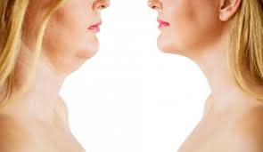Seventeen us states have officially backed the texas complaint to the us supreme court alleging that four states that certified the presidential election for democrat joe biden mismanaged them in. Kybella Now You Can Banish That Double Chin Without Surgery Elaine Phuah Do Mba Facoi Aesthetics