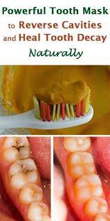 Powerful Tooth Mask To Reverse Cavities And Heal Tooth Decay Naturally Teeth Health Reverse Cavities Heal Cavities