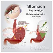 Pin On Gastritis Stomach Ulcers H Pylori