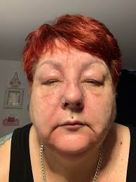 Can aloe cream help with F30i mask fit?