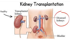 Kidney Transplant Doctor Hyderabad Dr Vijay Kiran Nephrologist At Nims