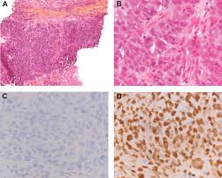 The Use of Immunohistochemistry Improves the Diagnosis of Small Cell Lung  Cancer and Its Differential Diagnosis. An International Reproducibility  Study in a Demanding Set of Cases - Journal of Thoracic Oncology