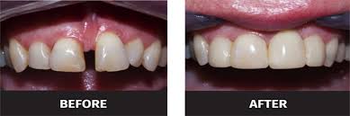 Jun 29, 2021 · occasionally it's possible to use veneers to fix missing teeth, but only if there is a very small gap left between two teeth. Black Triangle Teeth Treatment Uk