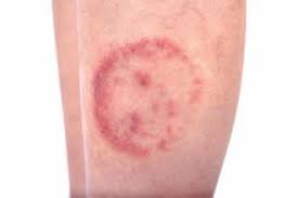 Image result for allergy rash on the legs