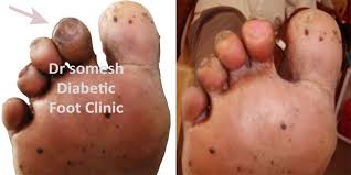 Image result for toe black diabetes