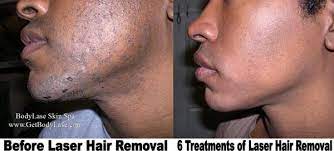 Permanent hair removal at home? Laser Hair Removal Raleigh Cary Bodylase Med Spa Nc