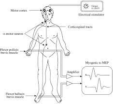 Usefulness Of Transcranial Motor Evoked Potentials During Thoracoabdominal Aortic Surgery The Annals Of Thoracic Surgery