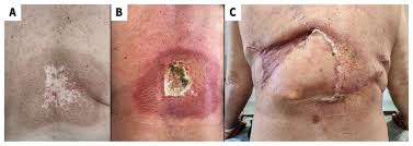 Image result for Radiation Dermatitis