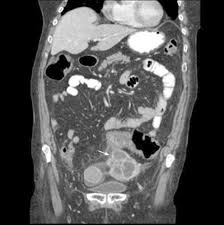 It's important to know what the warning signs are, as well as when to seek medical attention. Diverticulitis Presenting As A Tubo Ovarian Abscess With Subsequent Colon Perforation