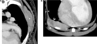 As a result, many individuals with pleural effusion suffer from shortness of breath. Can Malignant And Inflammatory Pleural Effusions In Dogs Be Distinguished Using Computed Tomography Watton 2017 Veterinary Radiology Amp Ultrasound Wiley Online Library
