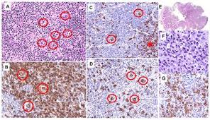 Frontiers Meningeal Relapse Of Nodular Lymphocyte Predominant Hodgkin Lymphoma Transformed To T Cell Histiocyte Rich Large B Cell Lymphoma A Case Report Oncology