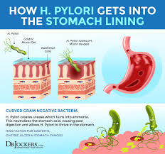 Learn more about risk factors, symptoms, a. The Damaging Effects Of H Pylori Infections Drjockers Com