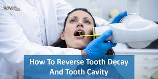Cavities are a type of tooth decay that occur when specific types of bacteria produce acid that destroys the tooth's enamel as well as the underlying layer, the dentin. How To Reverse Tooth Decay And Tooth Cavity Npda S