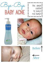 Bye Bye Baby Acne Simple Home Blessings Baby Acne Baby Rash Baby Acne Remedy