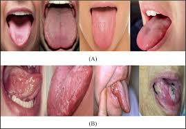 Image result for cancer of tongue