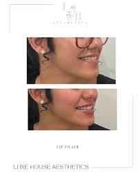 Just a boost of confidence injected 💉💋 Injector: @johnnierivera_rn . . .  . 📍Luxe House Aesthetics @luxehouseaesthetics 20 Main Street Port  Washington NY 11059 631.505.1036 #lip #lipfiller #ａｅｓｔｈｅｔｉｃ #medspalife  #longislandlipfiller ...