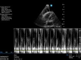 Image result for Collapsing Pulse