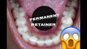 Retainers bonded only to the canines are easier to floss my favorite permanent retainer for the lower teeth is attached only to the two teeth at the end of the retainer using a little sleight of hand, it is possible to get the floss under these retainers without using a threader or superfloss. How To Care For Your Permanent Retainer 5 Facts