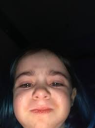 Spokane WA alopecia areata success story adoption