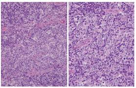 This lymphoma generally develops in the small intestine or colon. Angioimmunoblastic T Cell Lymphoma An Epstein Barr Virus Associated Bilineage Lymphoid Neoplasm Asian Archives Of Pathology