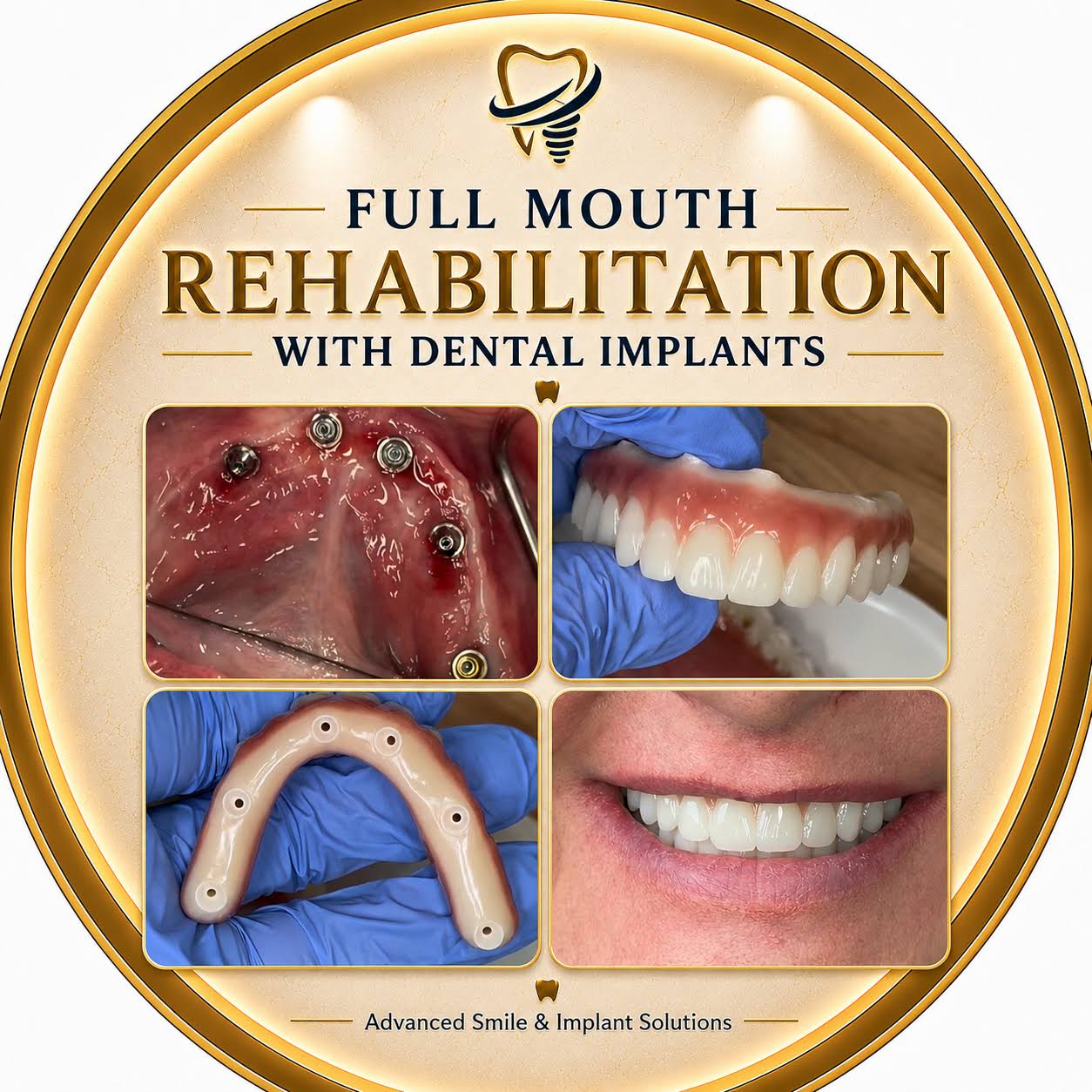 Full mouth rehabilitation with Dental implants in 10 days