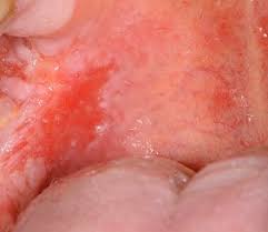 Image result for Erythroplakia roof of mouth