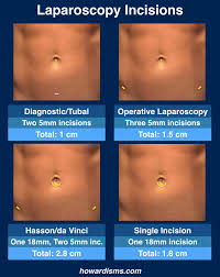 Four Tips To Reduce Pain After Laparoscopy