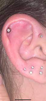 Thick Band Of Scabbing Skin Around The Cartilage Piercing And Keloid On Helix These Are Titanium And Were Done In November The Cartilage One Continuously Bleeds And I Clean It With Salt Water