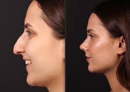 Only 28 days after closed approach soft tissue preservation and dorsal  preservation. Healing is fast. #rhinoplasty