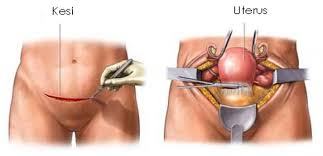 Maybe you would like to learn more about one of these? Rahim Kanseri Belirtileri Ve Tedavisi Nedir