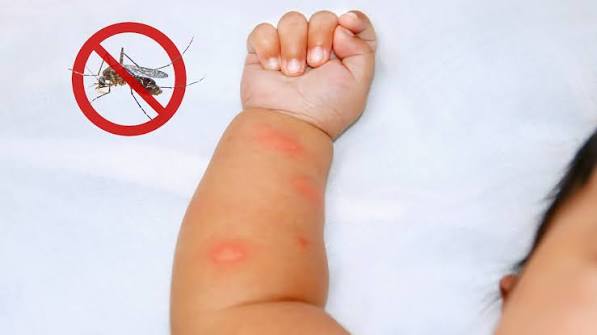 Nhấn vào ảnh để phóng to Nhận biết hình ảnh bệnh sốt xuất huyết ở trẻ em