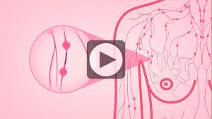 Breast cancer is the second most common cancer found in women — after skin cancer — but that doesn't mean men aren't at risk as well. Inflammatory Breast Cancer Symptoms Diagnosis Treatment National Breast Cancer Foundation