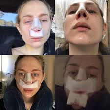 Nose Job Surgery Recovery Cast Removal Two Week Post Op Reveal Until The Very Trend Nose Job Nose Job Recovery Rhinoplasty Nose Jobs