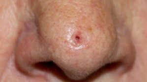 Image result for skin cancer on nose pimple