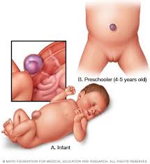 Check spelling or type a new query. Umbilical Hernia Symptoms And Causes Mayo Clinic