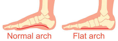 Many times, the first thing you may. Fallen Arch Guide Causes Symptoms And Treatment Options
