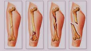 Amalkan Doa Penawar Ini Ikhtiar Untuk Masalah Tulang Patah Atau Retak Semuanya Jdt