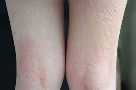 Maybe you would like to learn more about one of these? Telapak Tangan Gatal Ini Penyebab Dan Cara Mengatasinya