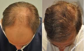 Internationaler kongress fue europe berlin 7. Haartransplantation