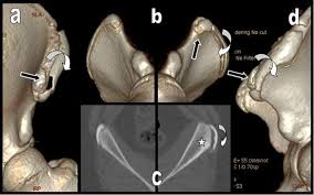 When to seek medical help. Acute Avulsion Of The Iliac Crest Apophysis In An Adolescent Indoor Soccer