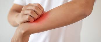 Objawy choroby z lyme są zróżnicowane, a niektóre z nich są podobne do innych chorób. Borelioza Objawy Diagnoza Leczenie Czym Jest Borelioza I Jak Ja Leczyc