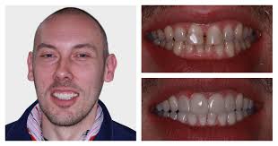 Dental Veneers Edinburgh