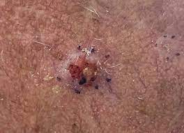 Skin cancer is one of the most common types of cancer. Basal Cell Carcinoma Wikipedia