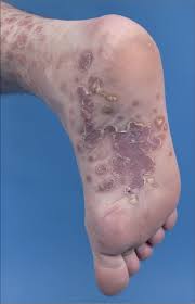 Syphilis can be successfully healed by antibiotic therapy. Clinical Update Syphilis In Adults The Lancet