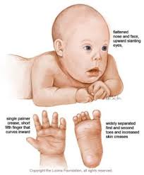 Down Syndrome Facts And Myths Optima
