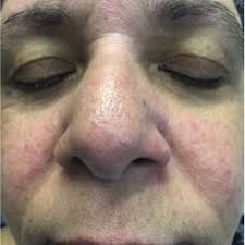 PDF) Global Epidemiology and Clinical Spectrum of Rosacea, Highlighting  Skin of Color: Review and Clinical Practice Experience