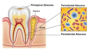 Image result for Periodontal Abscess