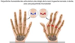 Pendant la journée, le pouce semble au si vous souhaitez une consultation personnelle pour epitact® orthèse pouce souple gauche l. Polyarthrite Rhumatoide Comment Attenuer La Douleur Bienvenue Sur Le Blog Djo France